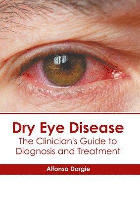 Dry Eye Disease The Clinician S Guide To Diagnosis And Treatment