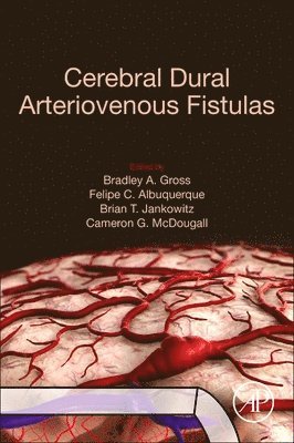 Cerebral Dural Arteriovenous Fistulas (hftad)