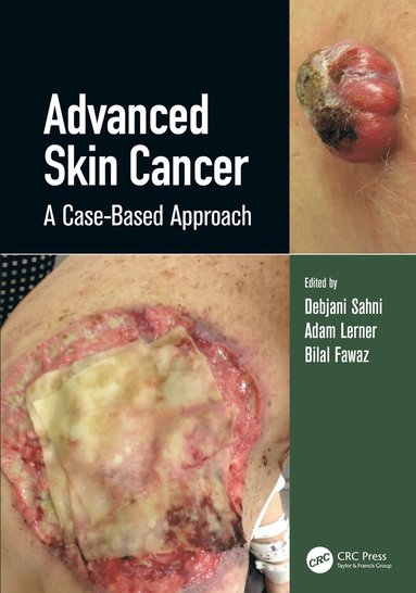 Advanced Skin Cancer (häftad)