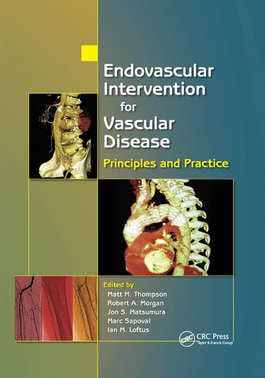 Endovascular Intervention for Vascular Disease (inbunden)