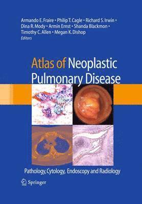 Atlas of Neoplastic Pulmonary Disease (inbunden)
