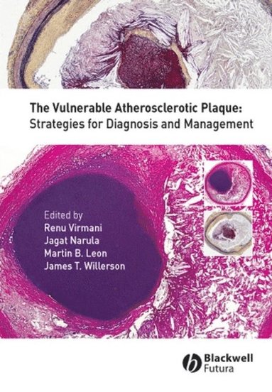 Vulnerable Atherosclerotic Plaque (e-bok)