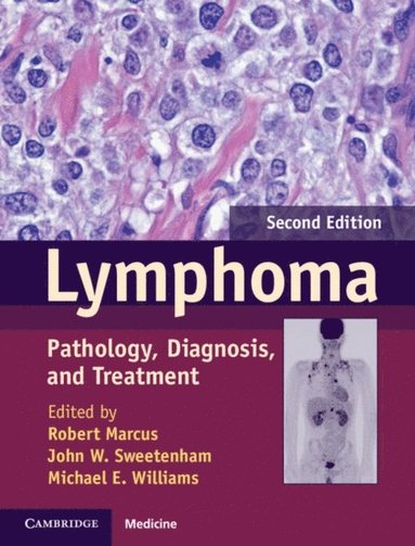 Lymphoma (e-bok)