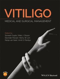 Vitiligo (e-bok)