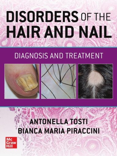 Disorders of the Hair and Nail: Diagnosis and Treatment (häftad)