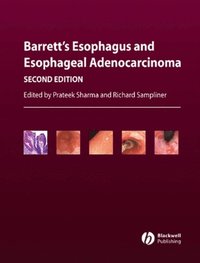 Barrett's Esophagus and Esophageal Adenocarcinoma (e-bok)