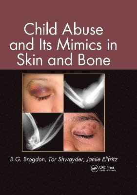 Child Abuse and its Mimics in Skin and Bone (inbunden)