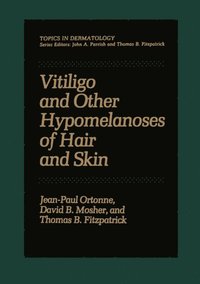 Vitiligo and Other Hypomelanoses of Hair and Skin (e-bok)