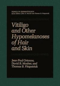 Vitiligo and Other Hypomelanoses of Hair and Skin (häftad)