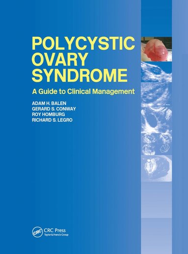 Polycystic Ovary Syndrome (hftad)