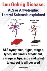 Lou Gehrig Disease, ALS or Amyotrophic Lateral Sclerosis explained. ALS symptoms, signs, stages, types, diagnosis, treatment, caregiver tips, aids and what to expect all covered. (hftad)