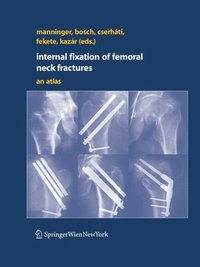 Internal fixation of femoral neck fractures (hftad)