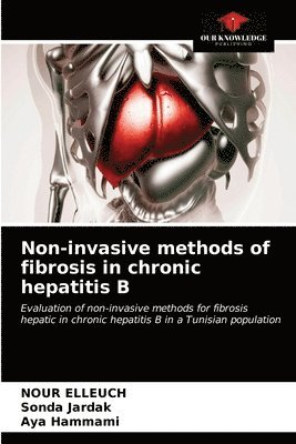Non-invasive methods of fibrosis in chronic hepatitis B (hftad)
