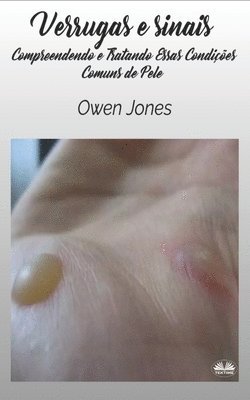 Verrugas e Sinais (h�ftad)