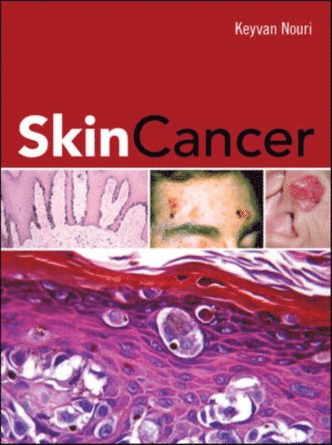 Keyvan Nouri - Skin Cancer, E-bok
