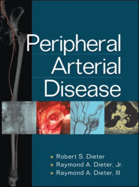 Raymond A. Dieter, Robert S. Dieter - Peripheral Arterial Disease, E-bok