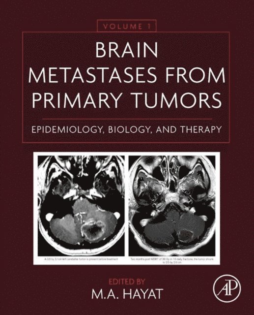 M. A. Hayat - Brain Metastases from Primary Tumors Volume 1, E-bok