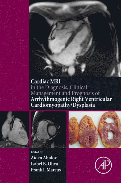 Frank I Marcus, Isabel Oliva, Aiden Abidov - Cardiac MRI in Diagnosis, Clinical Management, and Prognosis of Arrhythmogenic Right Ventricular Cardiomyopathy/Dysplasia, E-bok