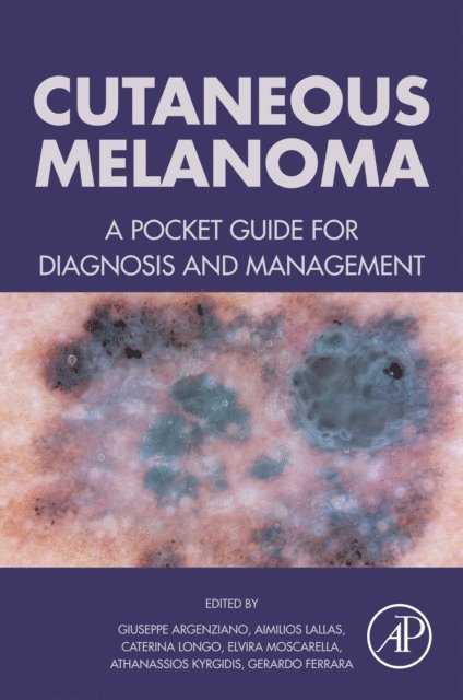 Gerardo Ferrara, Athanassios Kyrgidis, Elvira Moscarella, Caterina Longo, Aimilios Lallas, Giuseppe Argenziano - Cutaneous Melanoma, E-bok