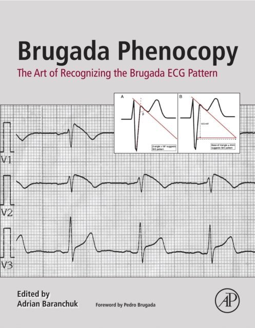 Adrian Baranchuk - Brugada Phenocopy, E-bok