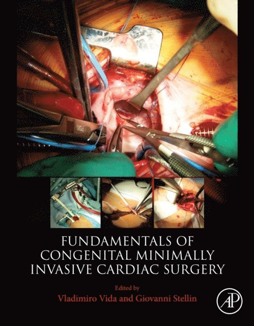 Giovanni Stellin, Vladimiro Vida - Fundamentals of Congenital Minimally Invasive Cardiac Surgery, E-bok
