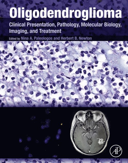 Herbert B. Newton, Nina A. Paleologos - Oligodendroglioma, E-bok