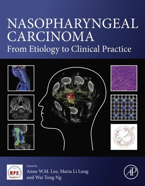 Wai Tong Ng, Maria Li Lung, Anne W.M. Lee - Nasopharyngeal Carcinoma, E-bok