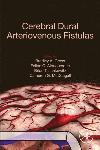 Cameron G. McDougall, Brian T. Jankowitz, Felipe C. Albuquerque, Bradley A. Gross - Cerebral Dural Arteriovenous Fistulas, E-bok