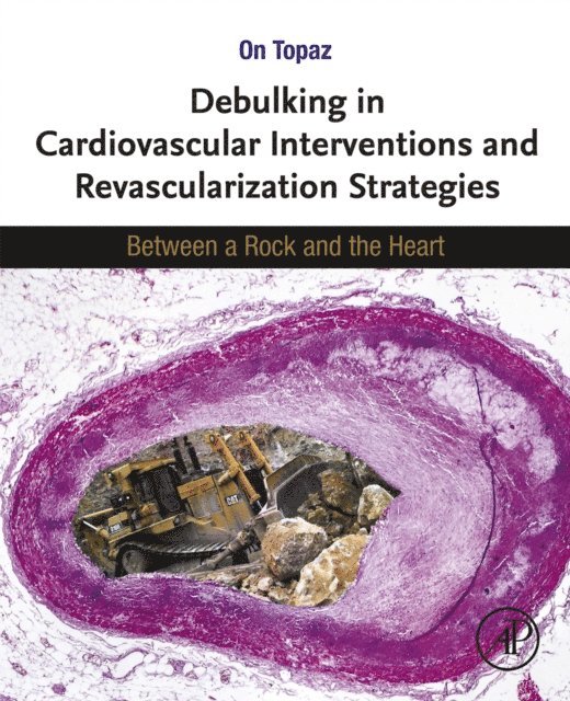 On Topaz - Debulking in Cardiovascular Interventions and Revascularization Strategies, E-bok. Tillgänglighet: Lägg i varukorg