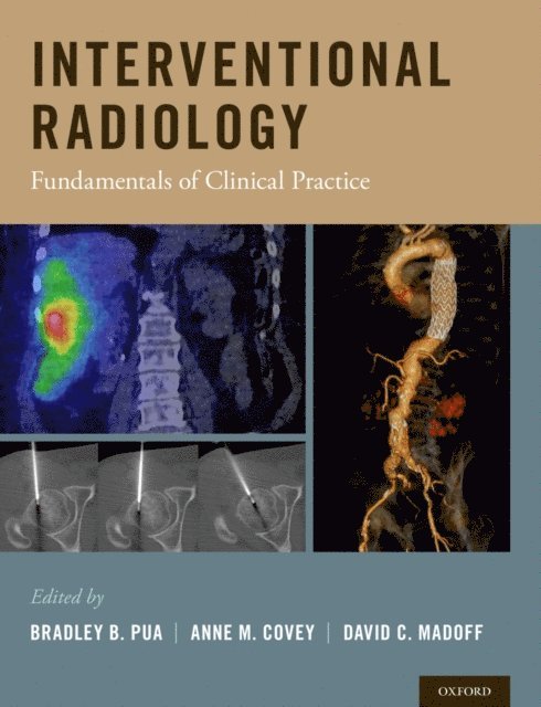 David C. Madoff, Anne M. Covey, Bradley B. Pua - Interventional Radiology, E-bok