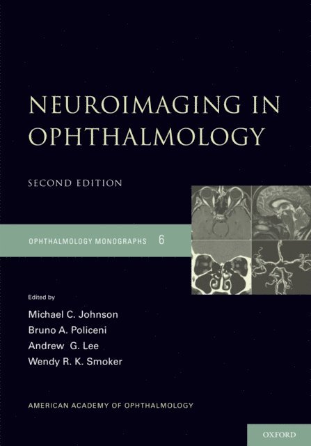 Wendy R.K. Smoker, Andrew G. Lee, Bruno Policeni, Michael C. Johnson - Neuroimaging in Ophthalmology, E-bok