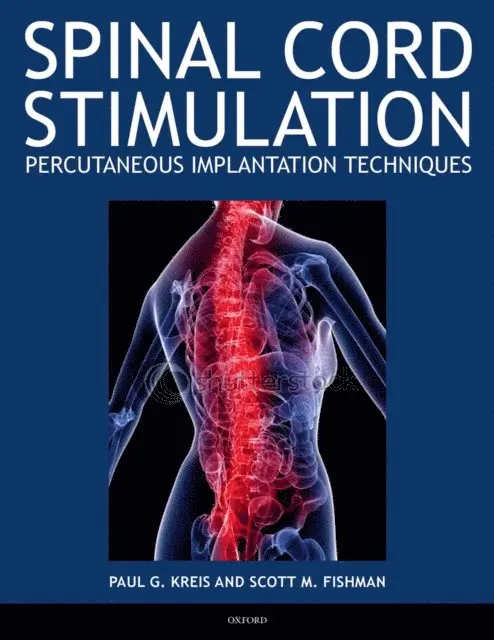 Scott Fishman, Paul Kreis - Spinal Cord Stimulation, E-bok. Tillgänglighet: Lägg i varukorg