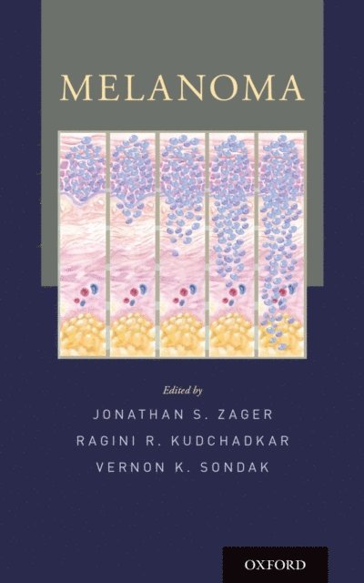 Ragini Kudchadkar MD, Vernon K. Sondak MD, Jonathan S. Zager MD - Melanoma, E-bok