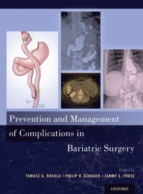 Tammy Fouse, Philip R. Schauer, Tomasz G. Rogula - Prevention and Management of Complications in Bariatric Surgery, E-bok