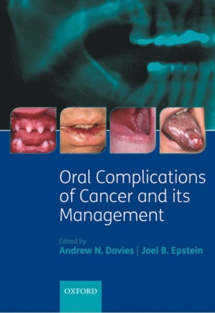 Joel Epstein, Andrew Davies - Oral Complications of Cancer and its Management, E-bok
