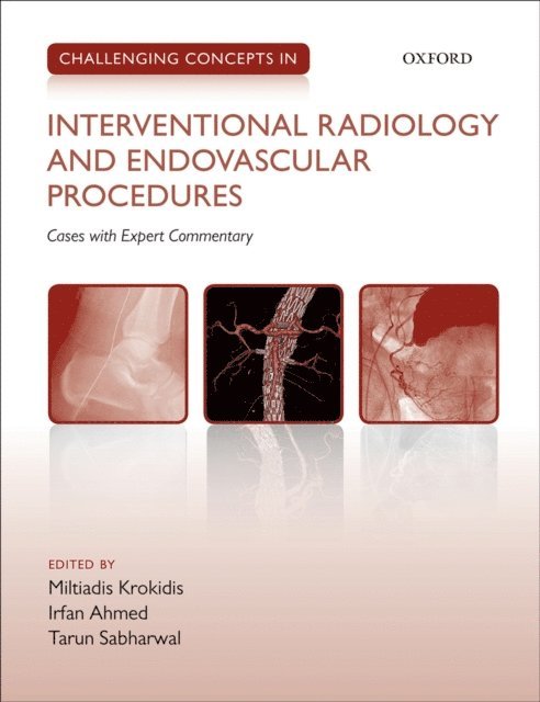 Tarun Sabharwal, Irfan Ahmed, Miltiadis Krokidis - Challenging Concepts in Interventional Radiology, E-bok