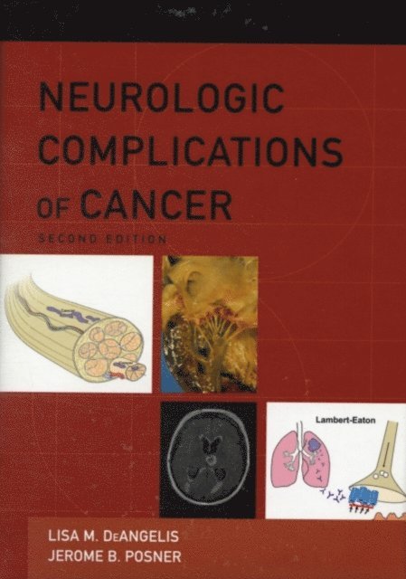 Jerome B Posner, Lisa M DeAngelis - Neurologic Complications of Cancer, E-bok