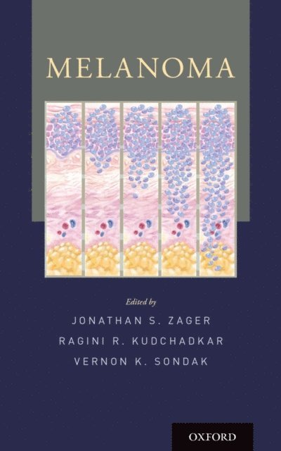 Ragini Kudchadkar MD, Vernon K. Sondak MD, Jonathan S. Zager MD - Melanoma, E-bok