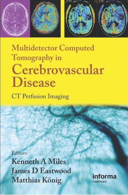 Matthias Konig, James D. Eastwood, Kenneth Miles - Multidetector Computed Tomography in Cerebrovascular Disease, E-bok
