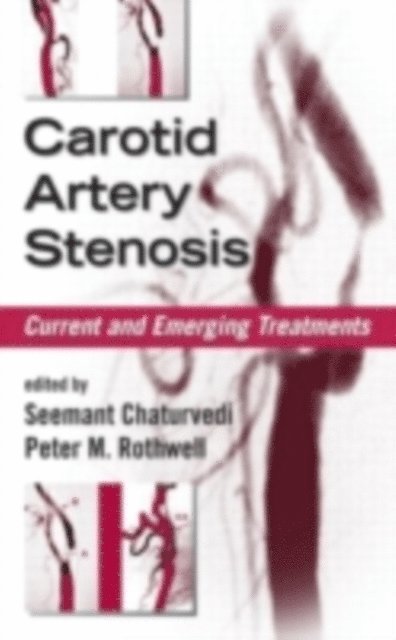 Peter M. Rothwell, Seemant Chaturvedi - Carotid Artery Stenosis, E-bok