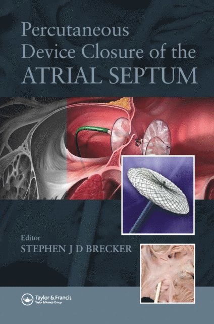 Stephen Brecker - Percutaneous Device Closure of the Atrial Septum, E-bok. Tillgänglighet: Lägg i varukorg