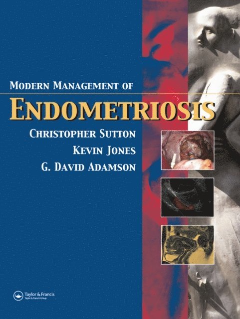 Kevin D. Jones, G. David Adamson, Christopher Sutton - Modern Management of Endometriosis, E-bok