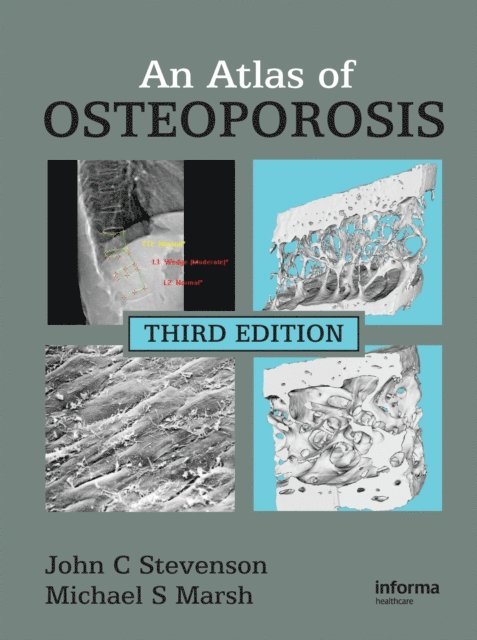 Michael S. Marsh, John C. Stevenson - Atlas of Osteoporosis, E-bok