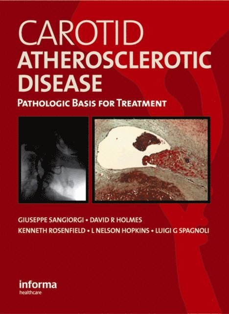 Luigi Spagnoli, L. Nelson Hopkins, Kenneth Rosenfield, David R. Holmes, Giuseppe Sangiorgi - Carotid Atherosclerotic Disease, E-bok