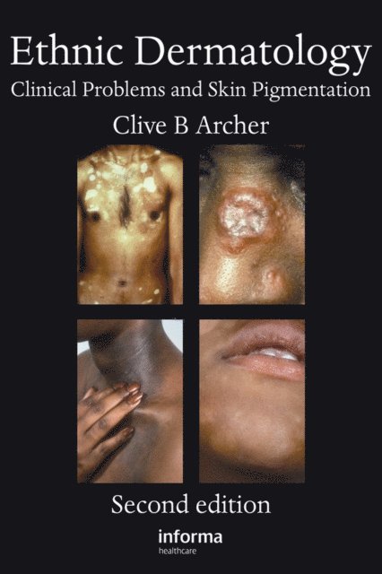 Clive B. Archer - Ethnic Dermatology, E-bok