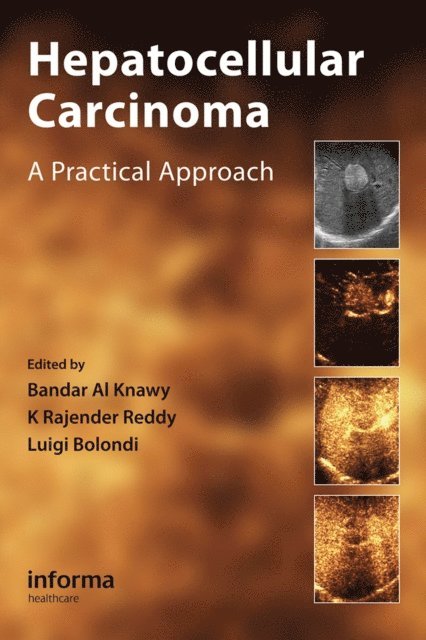 Luigi Bolondi, K. Rajender Reddy, Bandar Al Knawy - Hepatocellular Carcinoma, E-bok