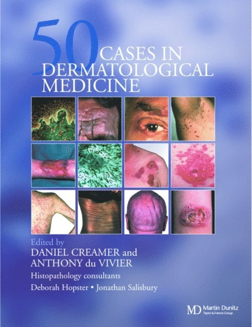 Anthony du Vivier, Daniel Creamer - Fifty Dermatological Cases, E-bok