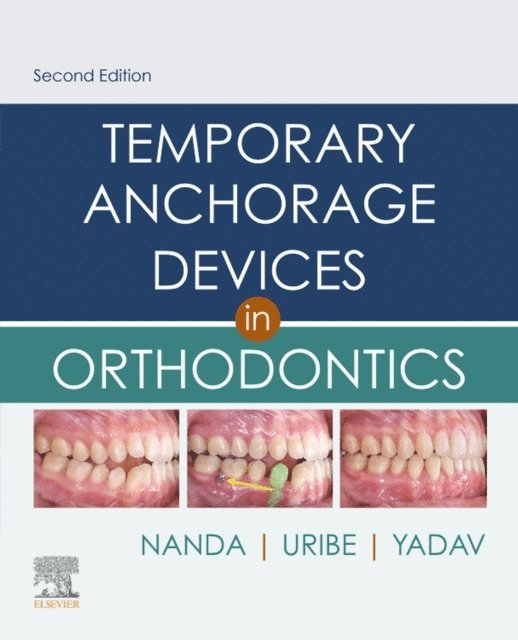 Sumit Yadav, Flavio Andres Uribe, Ravindra Nanda - Temporary Anchorage Devices in Orthodontics E-Book, E-bok