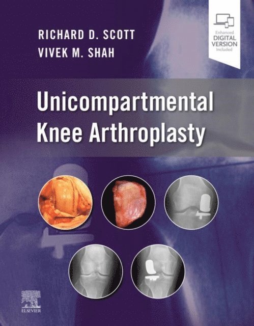 Vivek Shah, Richard D. Scott - Unicompartmental Knee Arthroplasty, E-Book, E-bok. Tillgänglighet: Lägg i varukorg