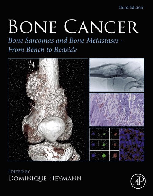 Dominique Heymann - Bone Cancer, E-bok. Tillgänglighet: Lägg i varukorg